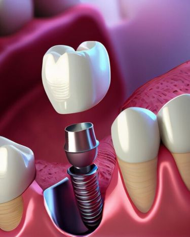 Implantes Smile Clinic